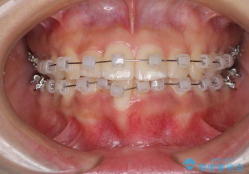 短期間での歯列矯正　ワイヤー矯正であっという間にの治療中