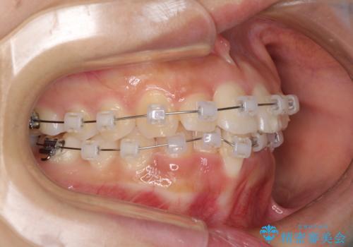 短期間での歯列矯正　ワイヤー矯正であっという間にの治療中