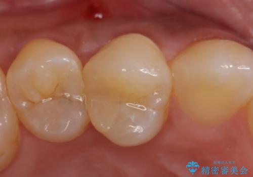 オールセラミッククラウン 歯茎の腫れが引かない歯の治療の治療前
