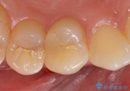 オールセラミッククラウン 歯茎の腫れが引かない歯の治療の治療前