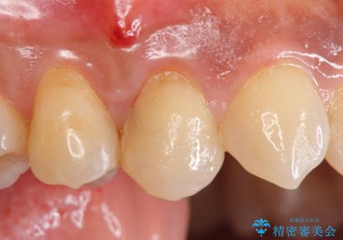 オールセラミッククラウン　歯茎の腫れが引かない歯の治療の治療前