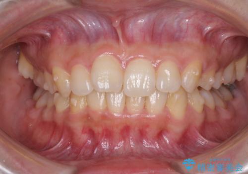 奥歯の倒れた歯を改善　インビザラインでの矯正治療の治療中