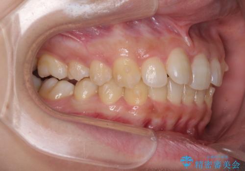 奥歯の倒れた歯を改善　インビザラインでの矯正治療の治療中