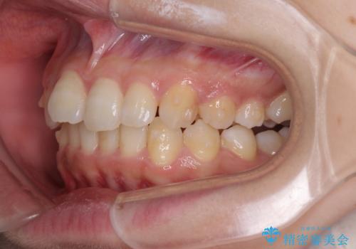 奥歯の倒れた歯を改善 インビザラインでの矯正治療の治療中