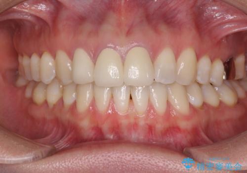 前歯の審美歯科治療 オールセラミッククラウンと部分矯正の治療後