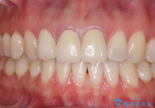 前歯の審美歯科治療　オールセラミッククラウンと部分矯正の治療後