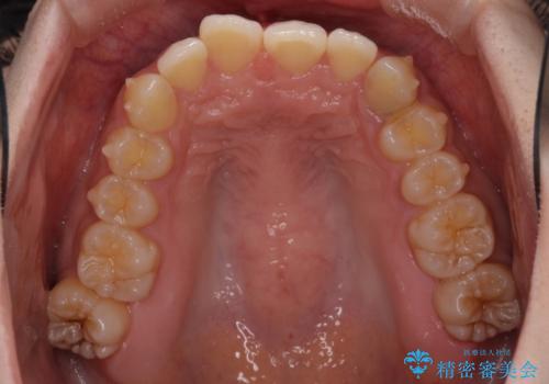 奥歯の倒れた歯を改善 インビザラインでの矯正治療の治療中