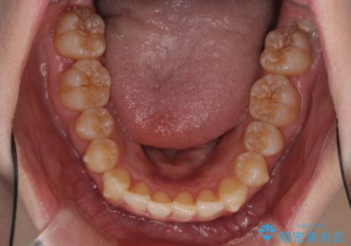 奥歯の倒れた歯を改善 インビザラインでの矯正治療の治療中