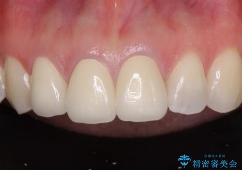 前歯の審美歯科治療 オールセラミッククラウンと部分矯正の治療後