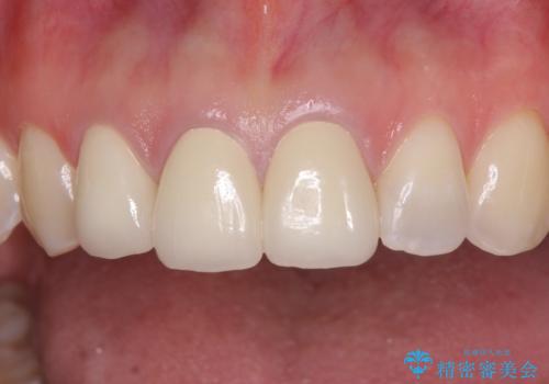 前歯の審美歯科治療 オールセラミッククラウンと部分矯正の治療後