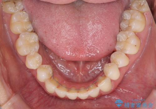 前歯の審美歯科治療 オールセラミッククラウンと部分矯正の治療後