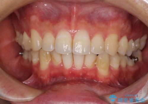 口が少し閉じにくい　インビザラインによる非抜歯矯正の治療中