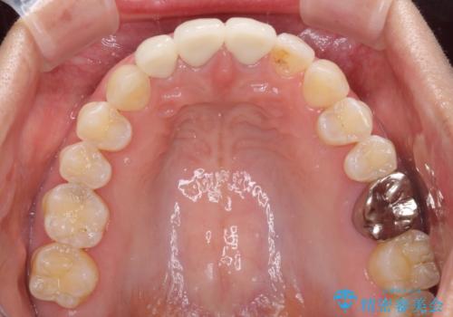 前歯の審美歯科治療 オールセラミッククラウンと部分矯正の治療後