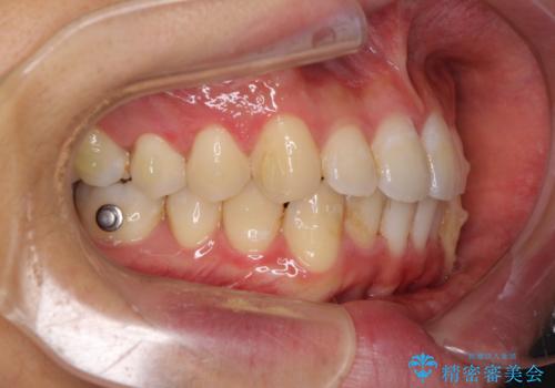 口が少し閉じにくい インビザラインによる非抜歯矯正の治療中
