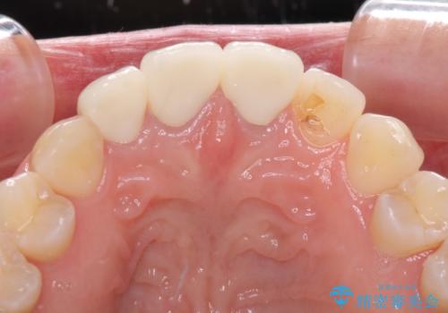 前歯の審美歯科治療　オールセラミッククラウンと部分矯正の治療後