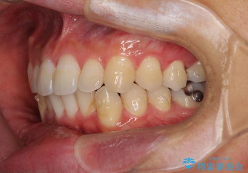 口が少し閉じにくい インビザラインによる非抜歯矯正の治療中