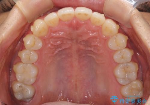 口が少し閉じにくい インビザラインによる非抜歯矯正の治療中