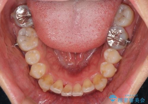 口が少し閉じにくい　インビザラインによる非抜歯矯正の治療中