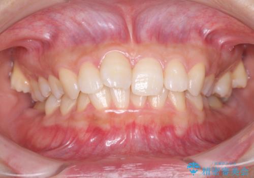 奥歯の倒れた歯を改善　インビザラインでの矯正治療の症例 治療前
