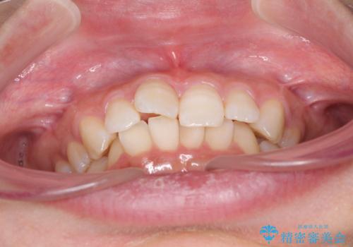 奥歯の倒れた歯を改善 インビザラインでの矯正治療の治療前