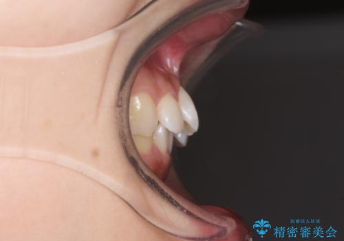 奥歯の倒れた歯を改善 インビザラインでの矯正治療の治療前