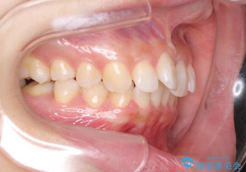 奥歯の倒れた歯を改善 インビザラインでの矯正治療の治療前