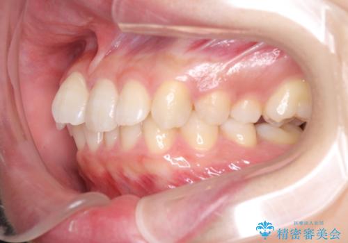 奥歯の倒れた歯を改善　インビザラインでの矯正治療の治療前