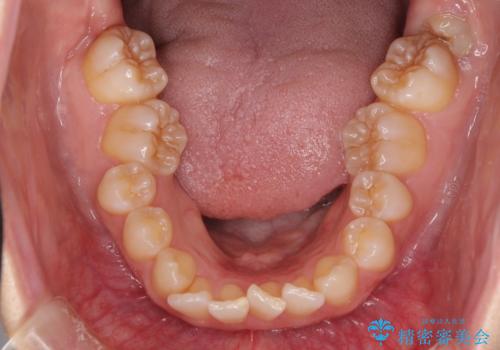奥歯の倒れた歯を改善　インビザラインでの矯正治療の治療前