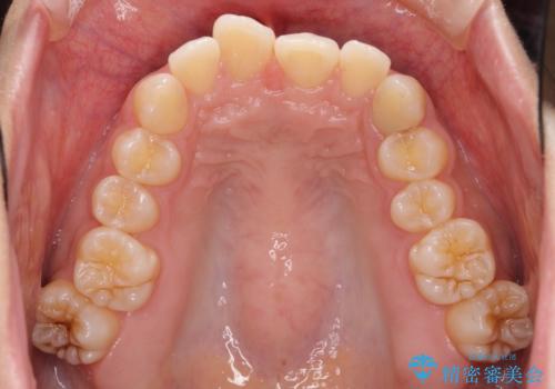 奥歯の倒れた歯を改善 インビザラインでの矯正治療の治療前