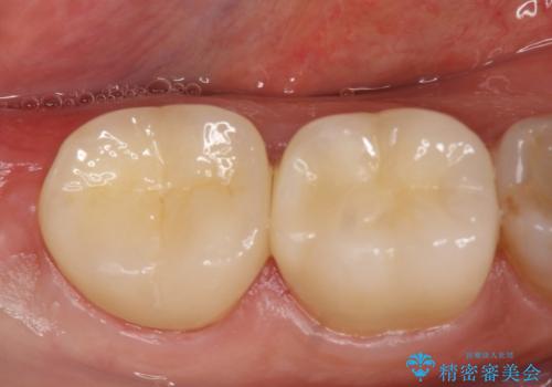 オールセラミッククラウン 奥歯の見た目の改善の症例 治療後
