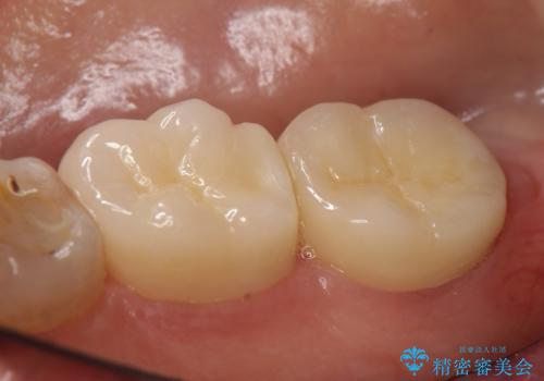 オールセラミッククラウン 奥歯の見た目の改善の治療後