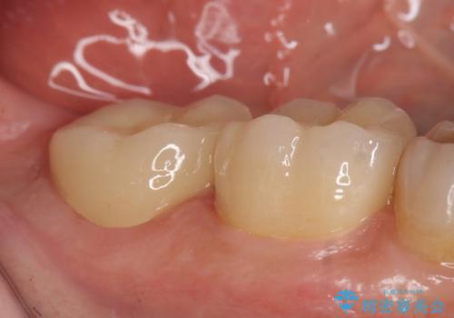 オールセラミッククラウン 奥歯の見た目の改善の治療後