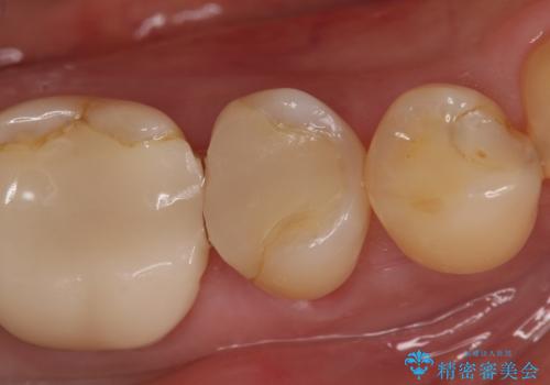 オールセラミッククラウン 神経が死んでいる歯の治療の治療前