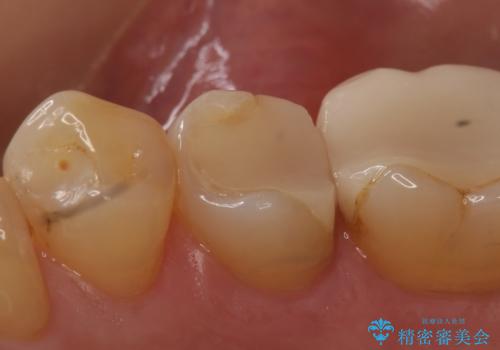 オールセラミッククラウン 神経が死んでいる歯の治療の治療前