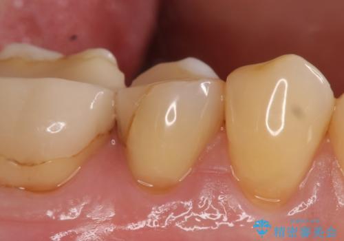 オールセラミッククラウン 神経が死んでいる歯の治療の治療前