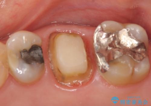 オールセラミッククラウン 口臭の原因であるフィステル(膿の出口)の治療の治療中