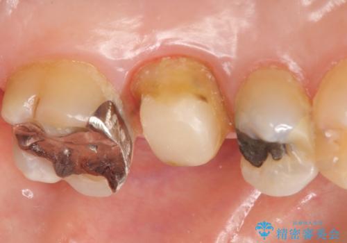 オールセラミッククラウン 口臭の原因であるフィステル(膿の出口)の治療の治療中