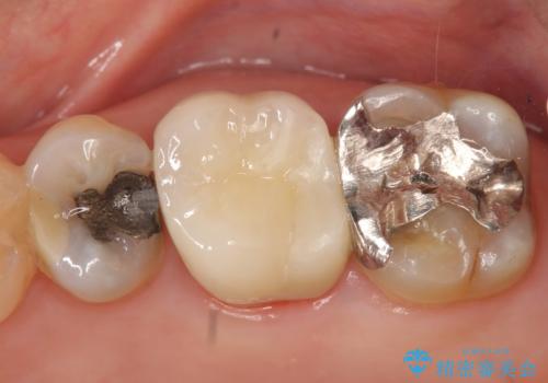 オールセラミッククラウン 口臭の原因であるフィステル(膿の出口)の治療の症例 治療後