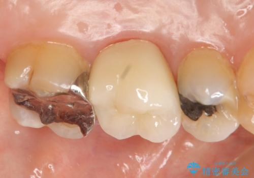 オールセラミッククラウン 口臭の原因であるフィステル(膿の出口)の治療の治療後