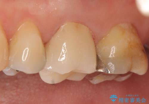 オールセラミッククラウン 口臭の原因であるフィステル(膿の出口)の治療の治療後
