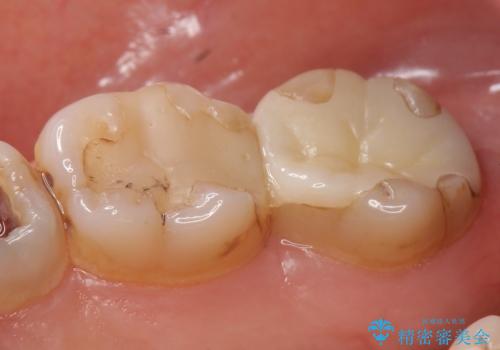 オールセラミッククラウン 奥歯の見た目の改善の治療前