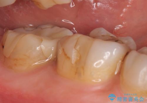 オールセラミッククラウン 奥歯の見た目の改善の治療前