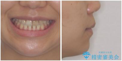 八重歯の抜歯矯正　費用を抑えた矯正装置の治療後（顔貌）