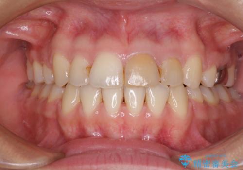 八重歯の抜歯矯正　費用を抑えた矯正装置の症例 治療後