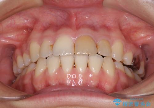 八重歯の抜歯矯正 費用を抑えた矯正装置の治療後