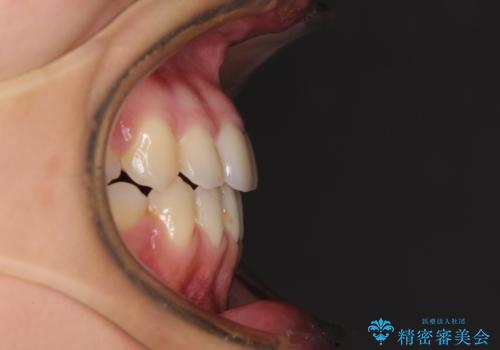 八重歯の抜歯矯正 費用を抑えた矯正装置の治療後