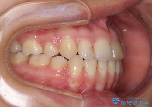 八重歯の抜歯矯正 費用を抑えた矯正装置の治療後