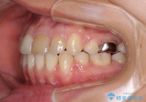 八重歯の抜歯矯正 費用を抑えた矯正装置の治療後