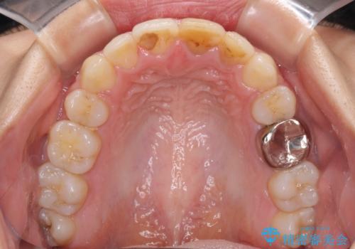 八重歯の抜歯矯正 費用を抑えた矯正装置の治療後