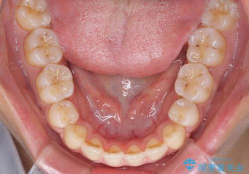 八重歯の抜歯矯正 費用を抑えた矯正装置の治療後